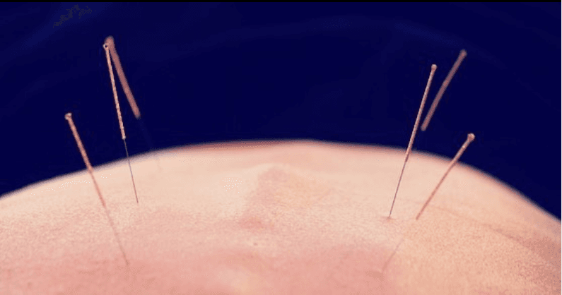 Mechanisms of Anti-inflammatory Acupuncture