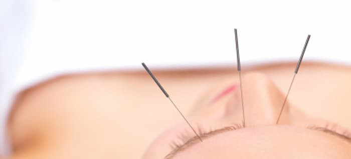 Acupuncture: Is It Painful?