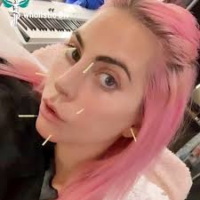 acupuntura estética
