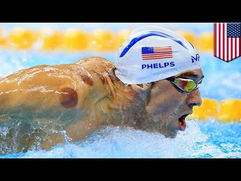 Micheal Phelps cupping marks