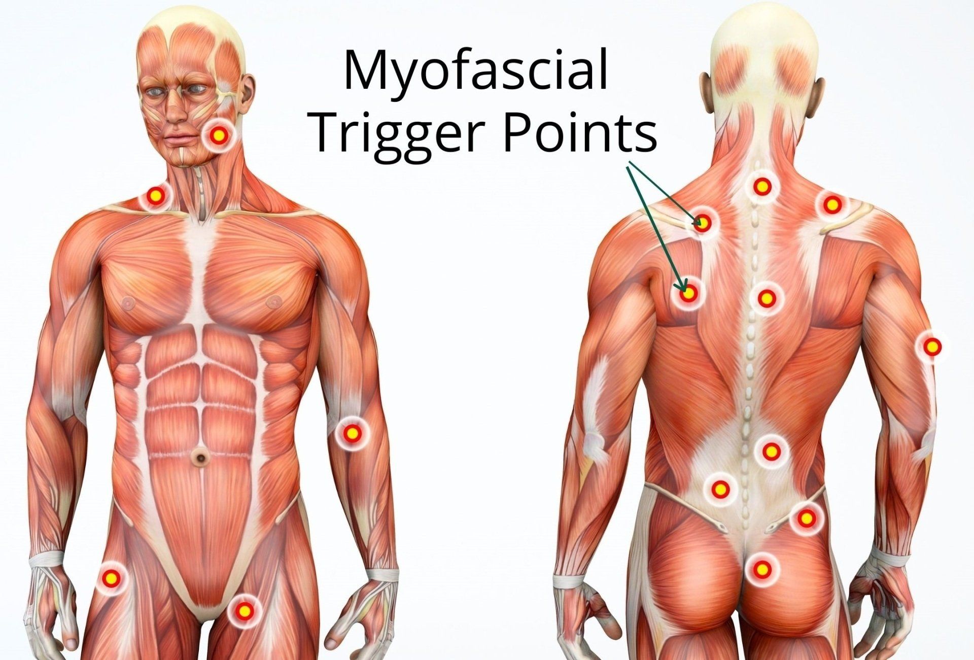 Trigger points